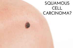 What is Squamous Cell Carcinoma?