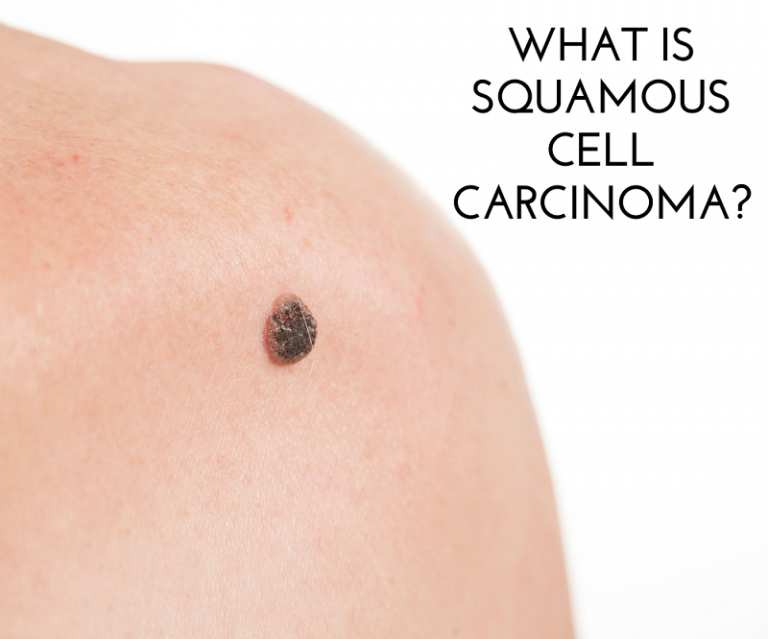 What is Squamous Cell Carcinoma? | Signature Skin Care